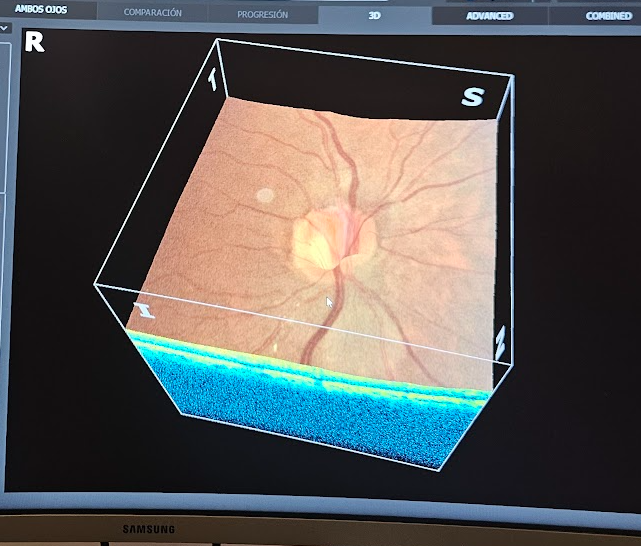 Visualización 3D de tomografía de coherencia óptica (OCT) en Oftalmo-IA